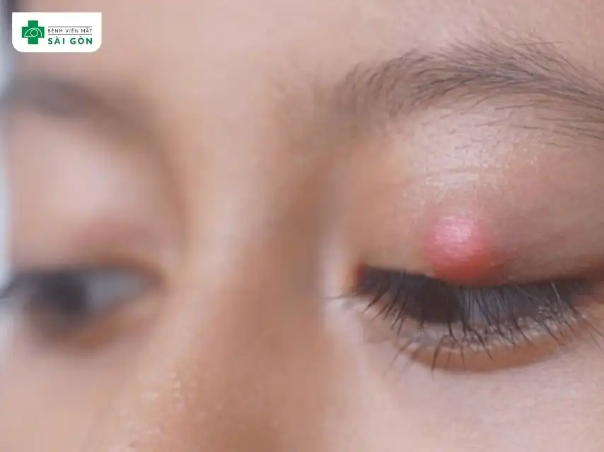 Chắp do sụn mi bị bít