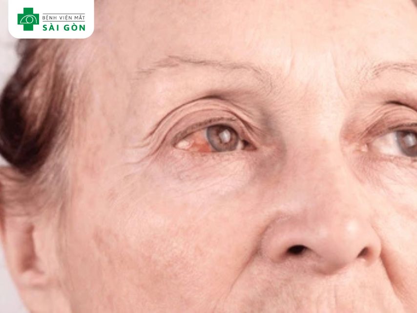 Vết thương hoặc tổn thương trên bề mặt giác mạc