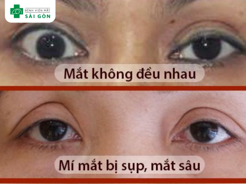 Lựa chọn cơ sở phẫu thuật cắt mí mắt