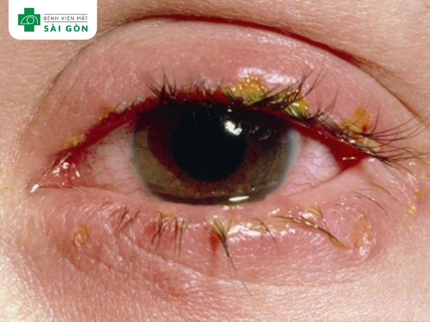 Tiết dịch (ghèn) là biểu hiện của đau mắt đỏ.