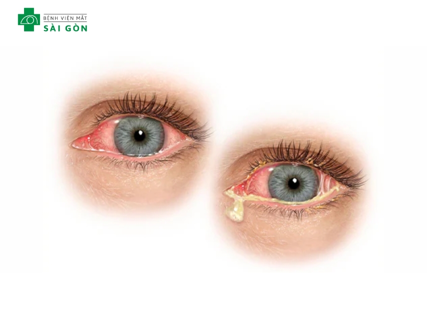 Đau mắt đỏ là viêm bề mặt mắt do nhiễm trùng hoặc kích ứng