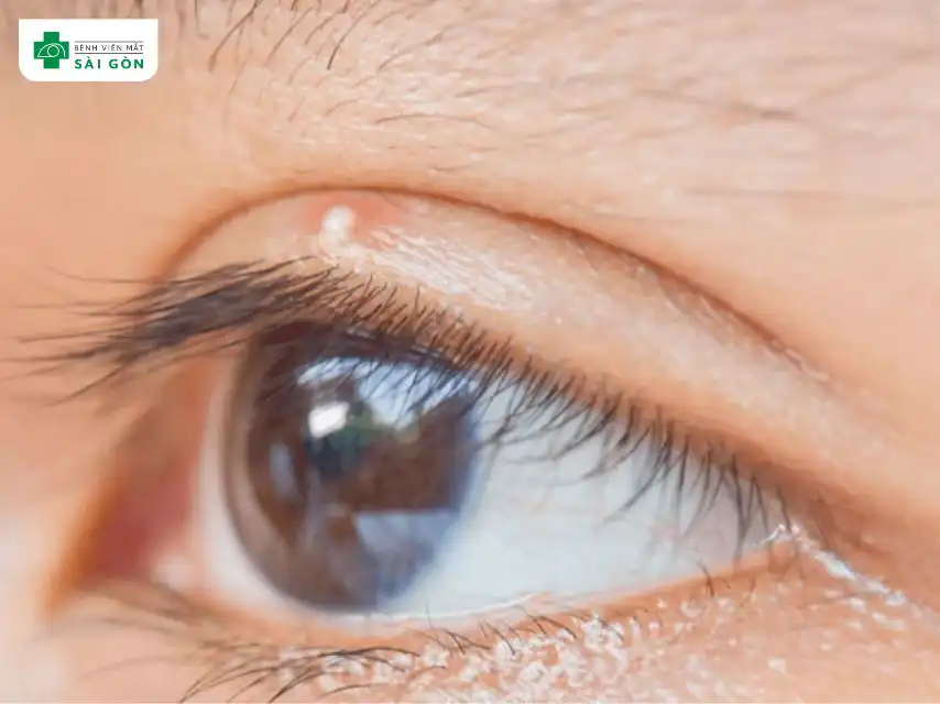 Tùy vào từng loại mụn mà sẽ có dấu hiệu khác nhau