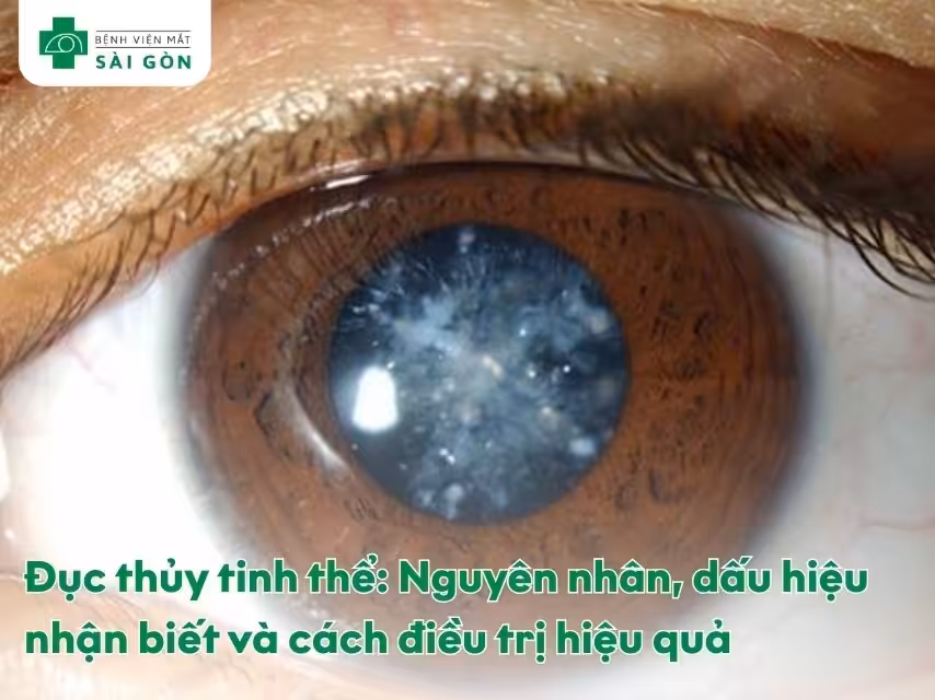 Đục thủy tinh thể là gì