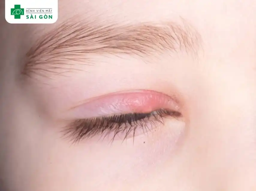 Lẹo mắt xuất hiện với các triệu chứng đặc trưng