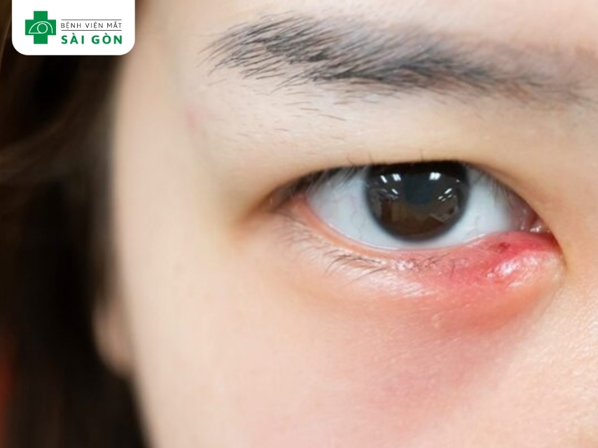 Khối u nhỏ xuất hiện bên trong mí mắt là mụn lẹo