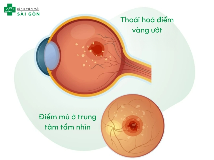 Thoái hóa điểm vàng phụ thuộc vào giai đoạn và loại bệnh