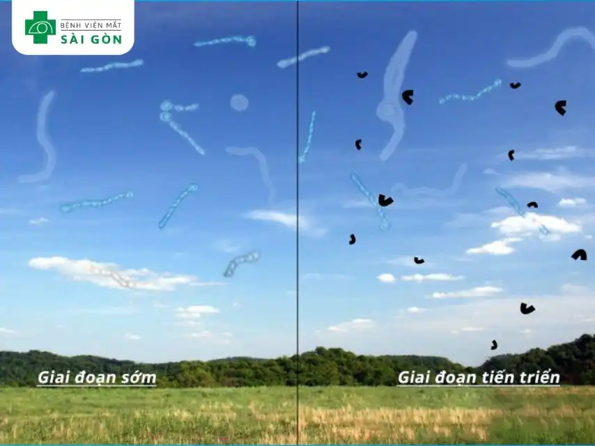 Dấu hiệu phổ biến nhất là xuất hiện các hình dạng nhỏ trong tầm nhìn