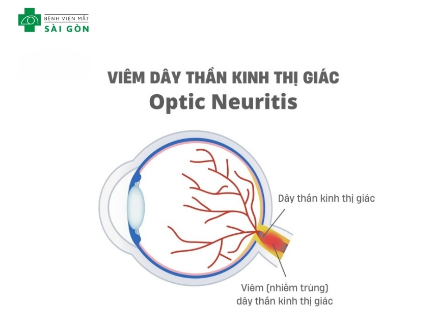 Viêm dây thần kinh thị giác gây đau hốc mắt