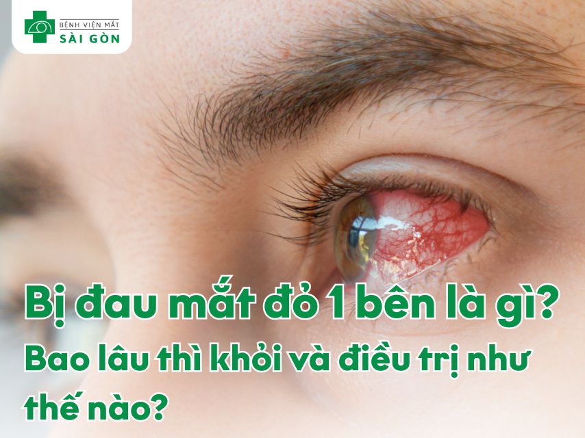 Hội chứng đau mắt đỏ 1 bên