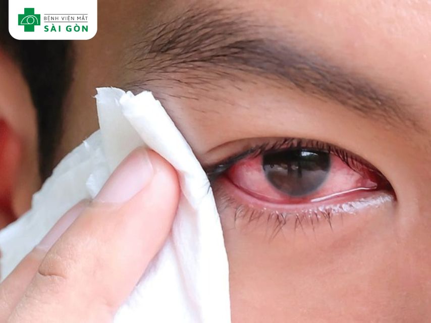 Dị vật trong mắt