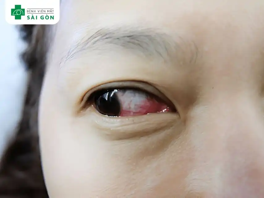 Dấu hiệu viêm kết mạc