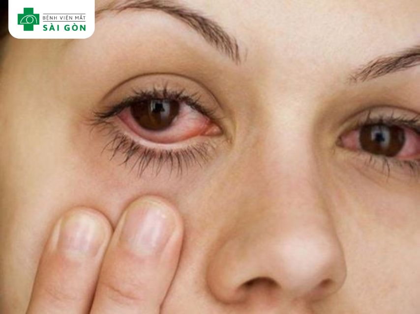 Đau mắt đỏ có khả năng lây truyền
