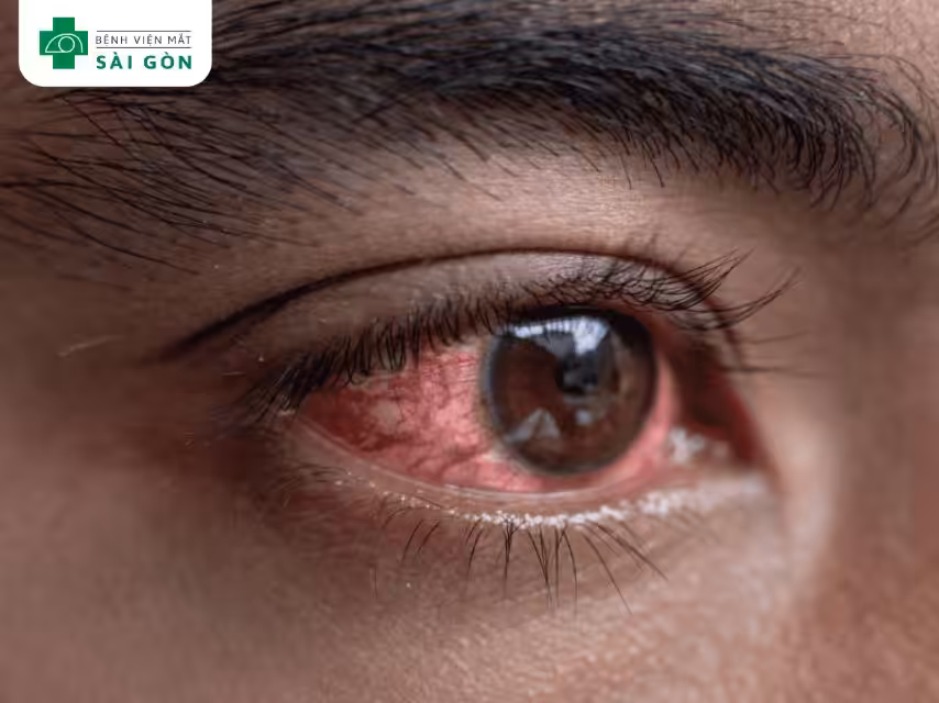 Viêm nhiễm gây đau mắt