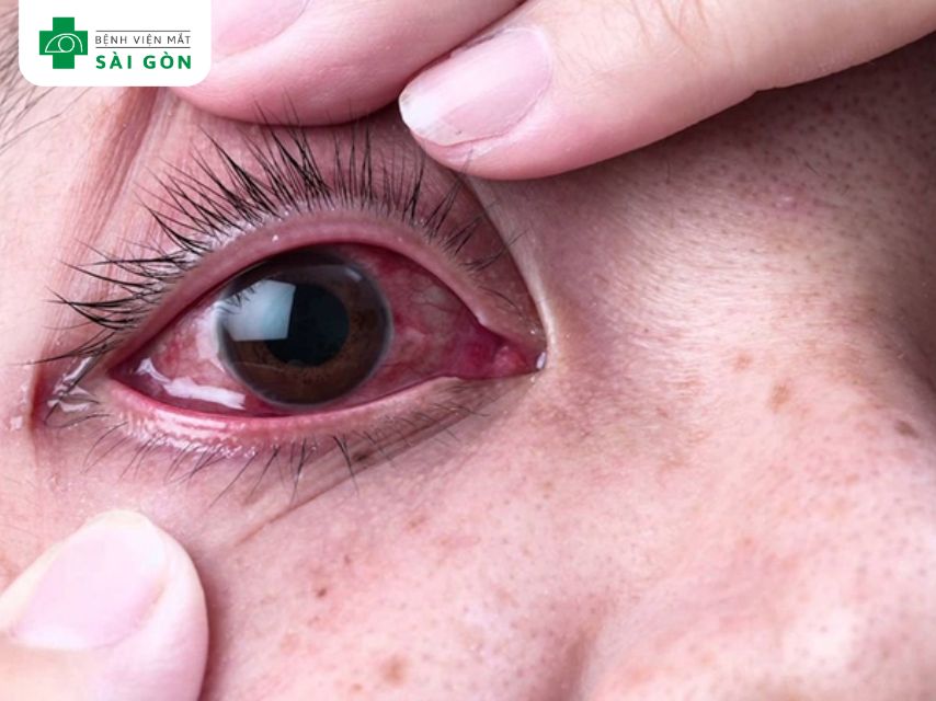 Đau mắt hàn là gì