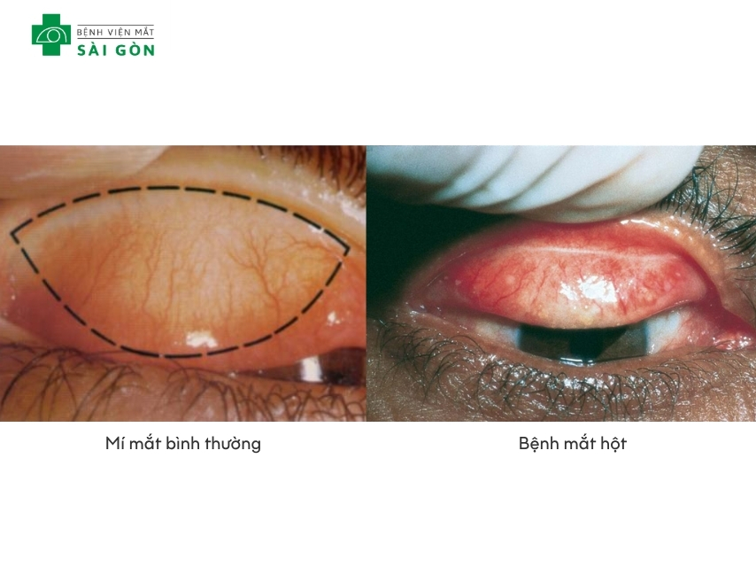 Đau mắt hột là bệnh nhiễm trùng mắt có thể gây mù lòa nếu không điều trị sớm