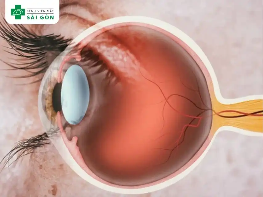 Mỗi người có một dây thần kinh thị giác nằm ở phía sau mỗi mắt