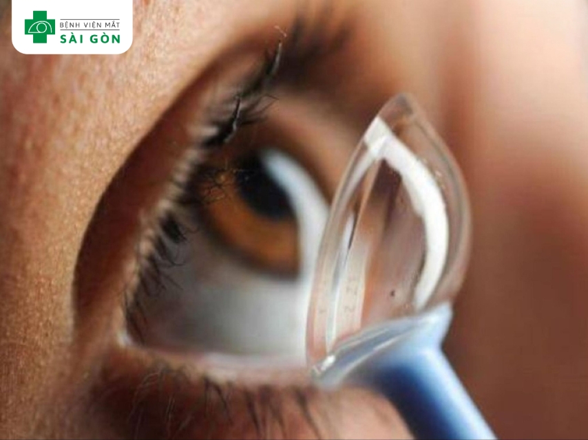 Kính Ortho - K cải thiện thị lực