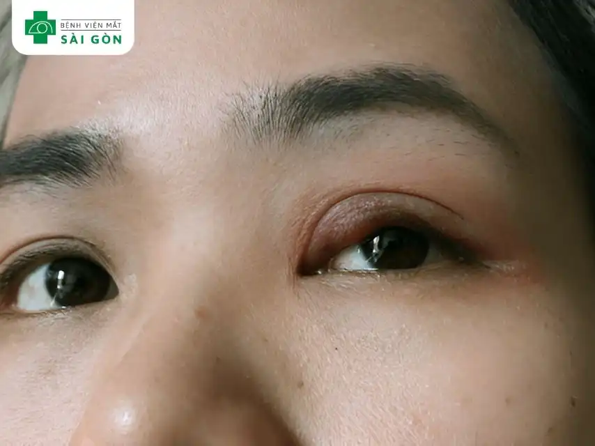 Dị ứng ở mắt