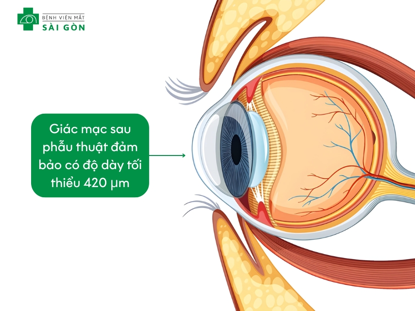 Độ dày giác mạc mắt còn sau khi mổ
