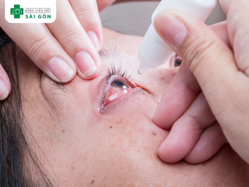 Điều trị hiện đại giúp can thiệp hiệu quả các bệnh lý giác mạc