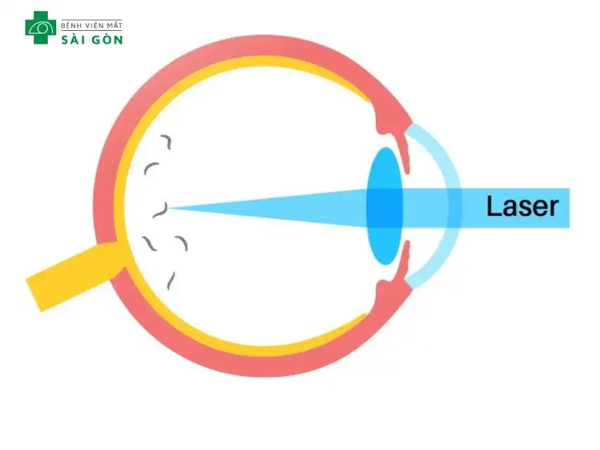 Điều trị bằng laser (vitreolysis) có thể được áp dụng