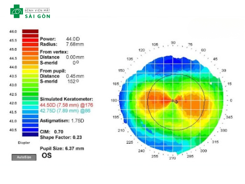 Kiểm tra độ cong giác mạc xác định loạn thị