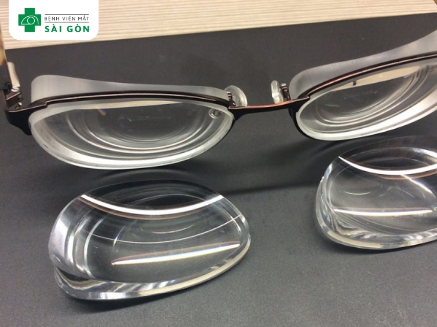 Người bị cận thị cao không sử dụng Ortho-K