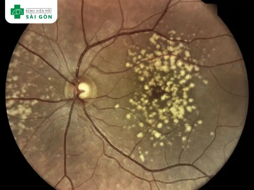 Drusen thần kinh thị giác