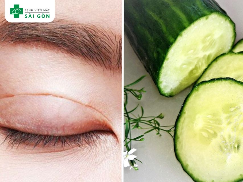 Dưa leo giúp giảm sưng và bọng mắt