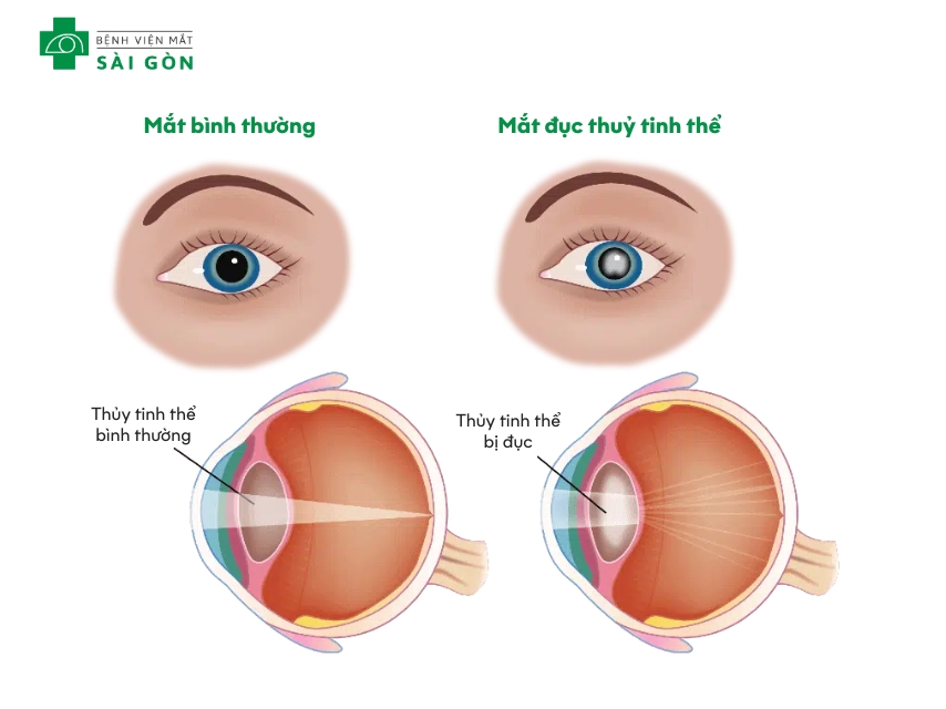 Đục thủy tinh thể gây mờ đục thủy tinh thể và giảm thị lực