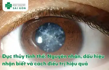 Đục thủy tinh thể là gì