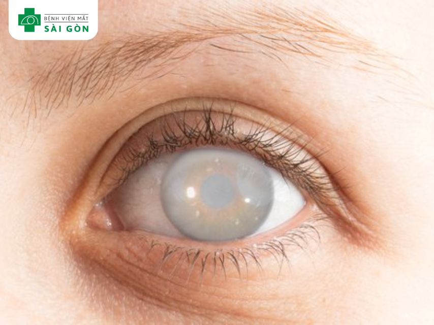 Đục thủy tinh thể