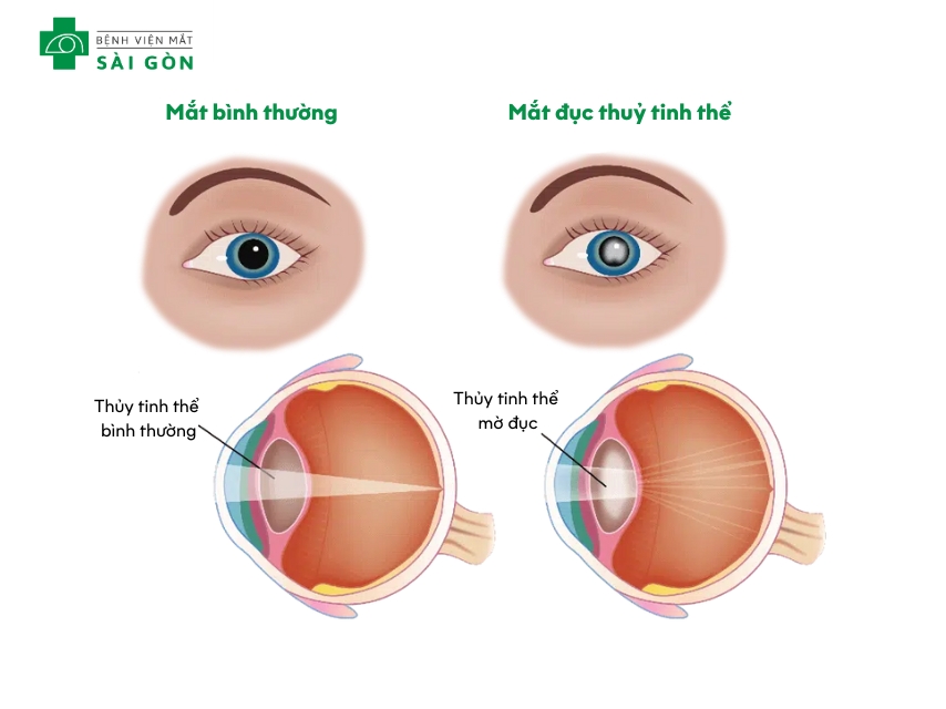Đục thủy tinh thể gây mờ mắt