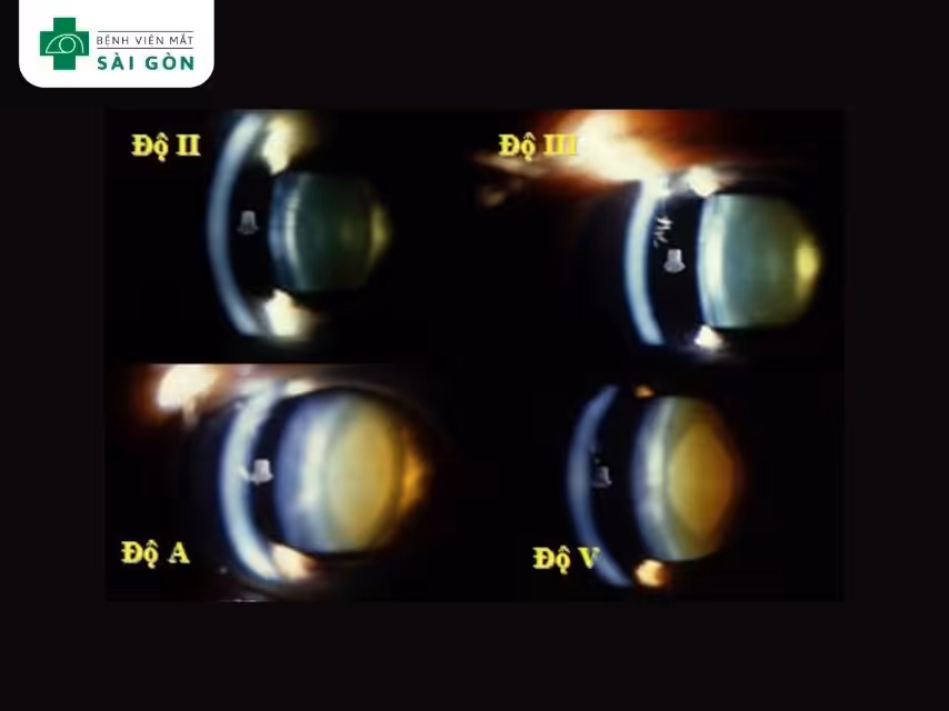 Phân loại theo thang Luicio-Burrato