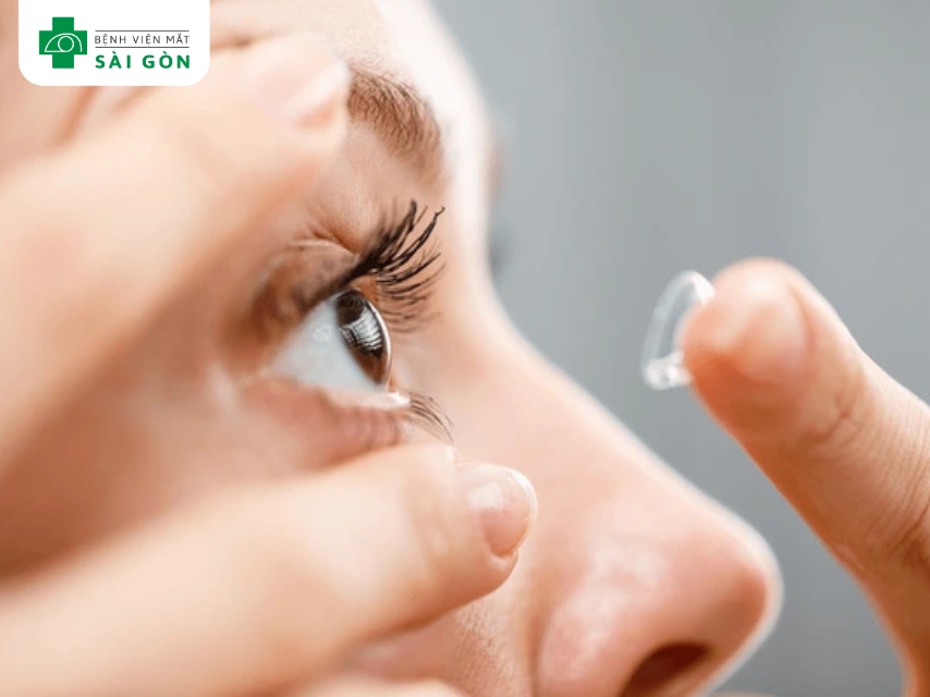 Đeo kính áp tròng lâu dài tăng nguy cơ dị ứng