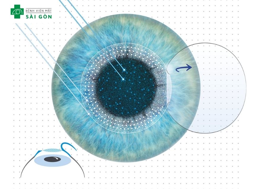 Phẫu thuật LASIK bằng phương pháp FEMTO Pro