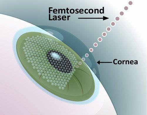 femtosecond laser