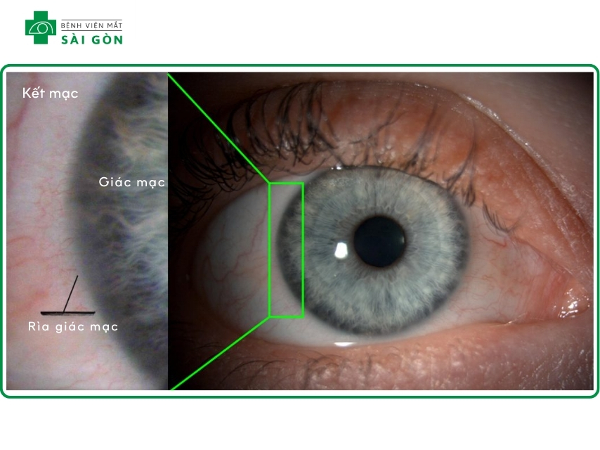 Giác mạc là có vai trò quan trọng trong khúc xạ ánh sáng