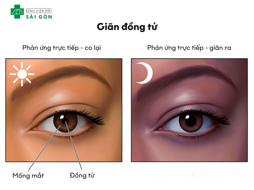 Tình trạng mắt co giãn bất thường