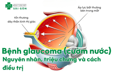 Tìm hiểu tổng quan bệnh glaucoma