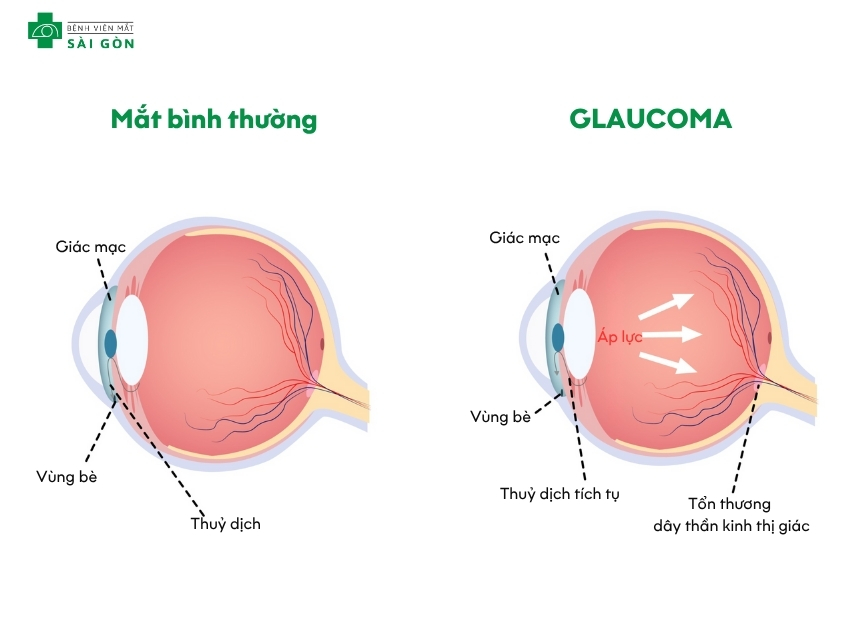 Glaucoma gây tổn thương thị giác nghiêm trọng