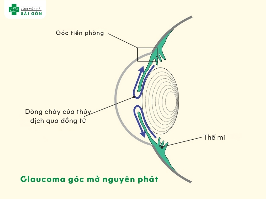 Glaucoma góc mở nguyên phát là dạng phổ biến nhất.
