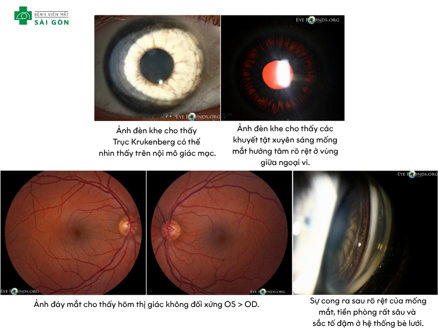 Glaucoma sắc tố thường ở người trẻ và cận thị