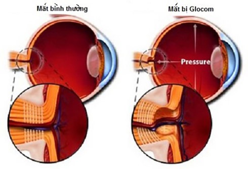 Glocom nhãn áp không cao: Căn bệnh dễ gây mù lòa