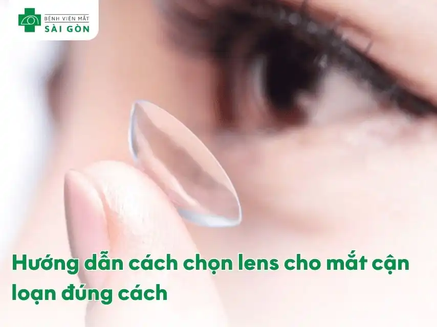 Kính áp tròng là giải pháp tiện lợi cho người cận loạn