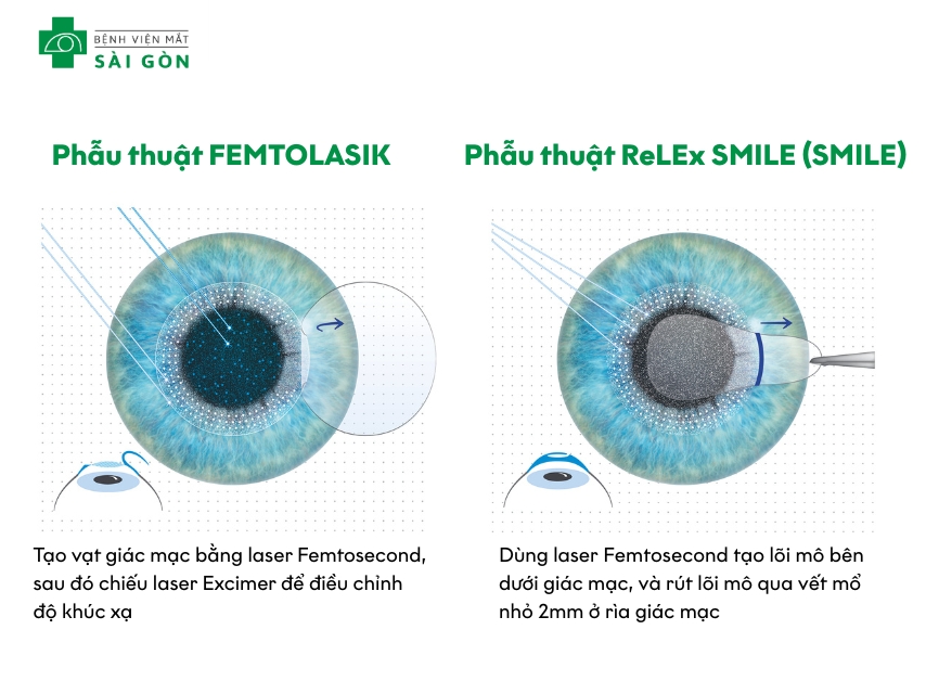 Điểm khác nhau của hai phương pháp FEMTOLASIK và ReLEx SMILE