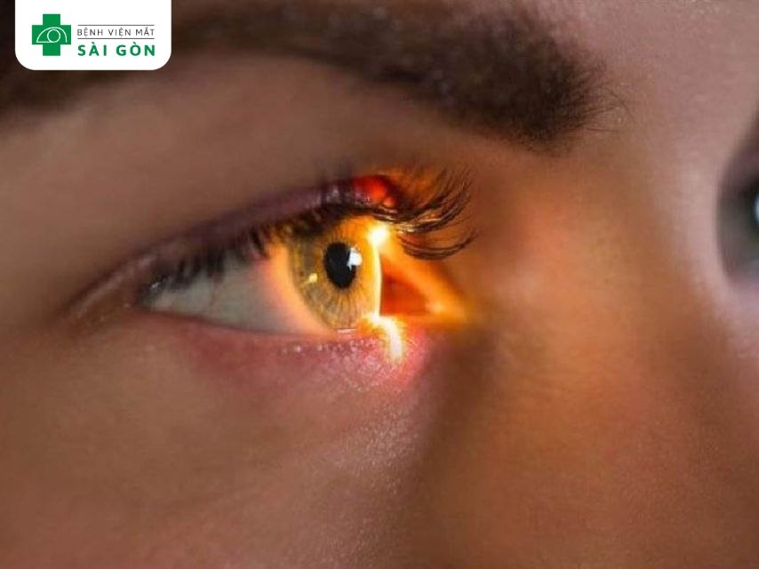 Quáng gà là thị lực kém trong môi trường tối hoặc ban đêm