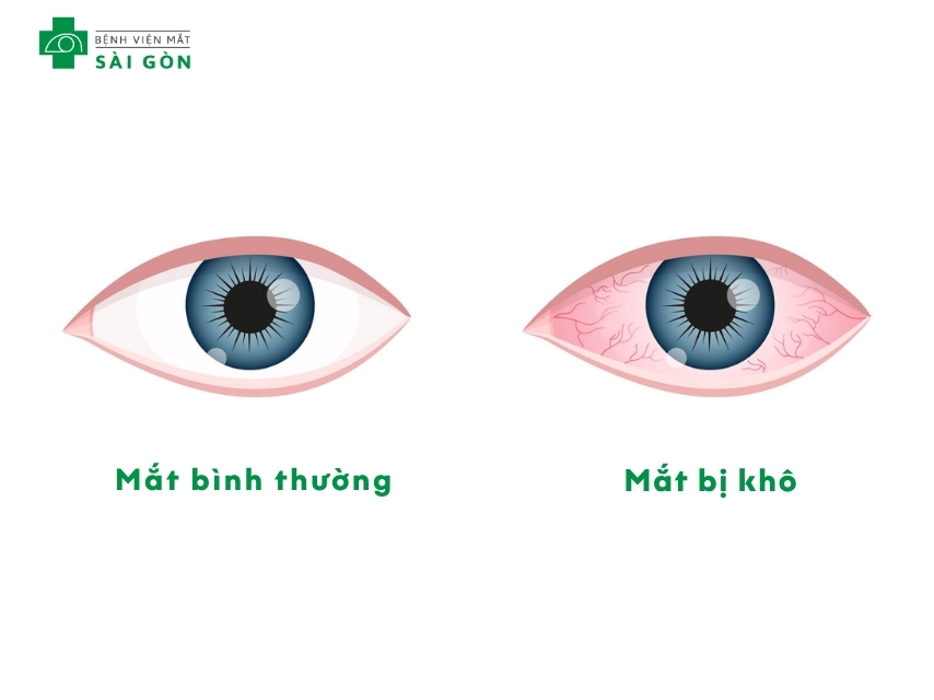 Khô mắt là tình trạng nước mắt bị thiếu