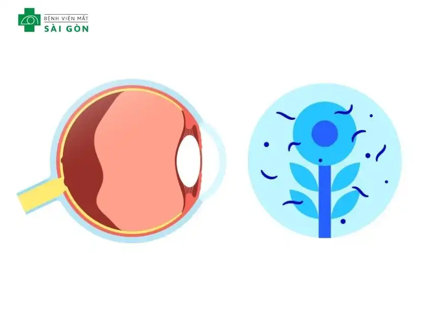 Khối u có thể gây vẩn đục dịch kính