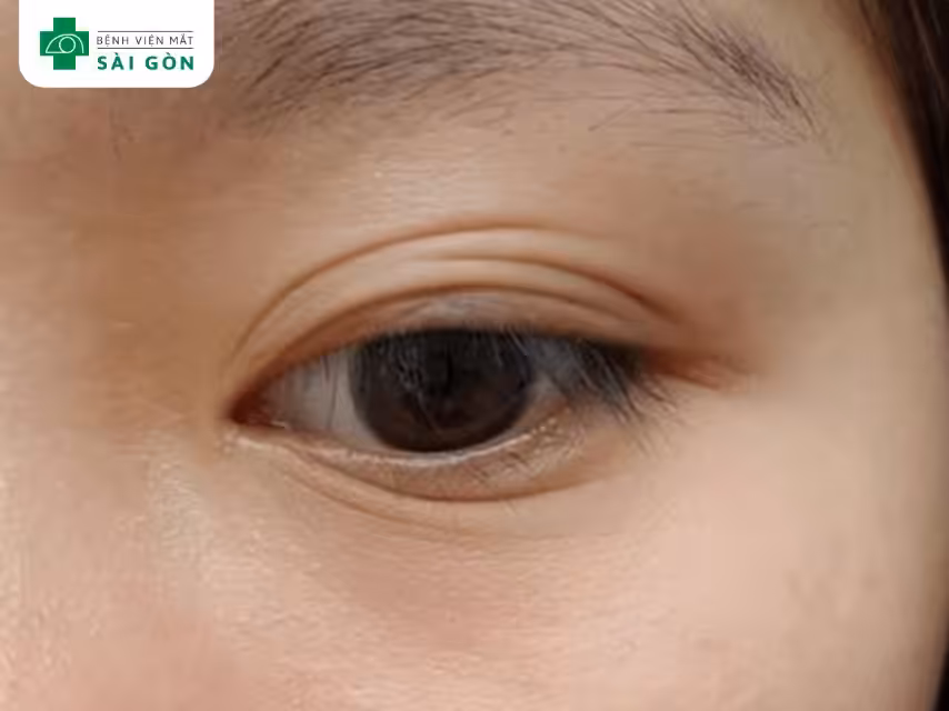 Mắt nhiều nếp mí